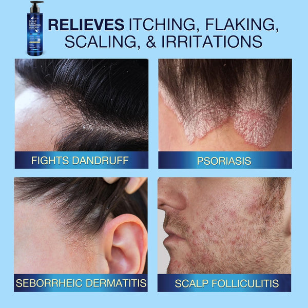 Scalp Calm Shampoo for Scalp Psoriasis